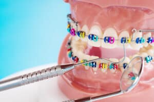 Brentwood Metal Braces